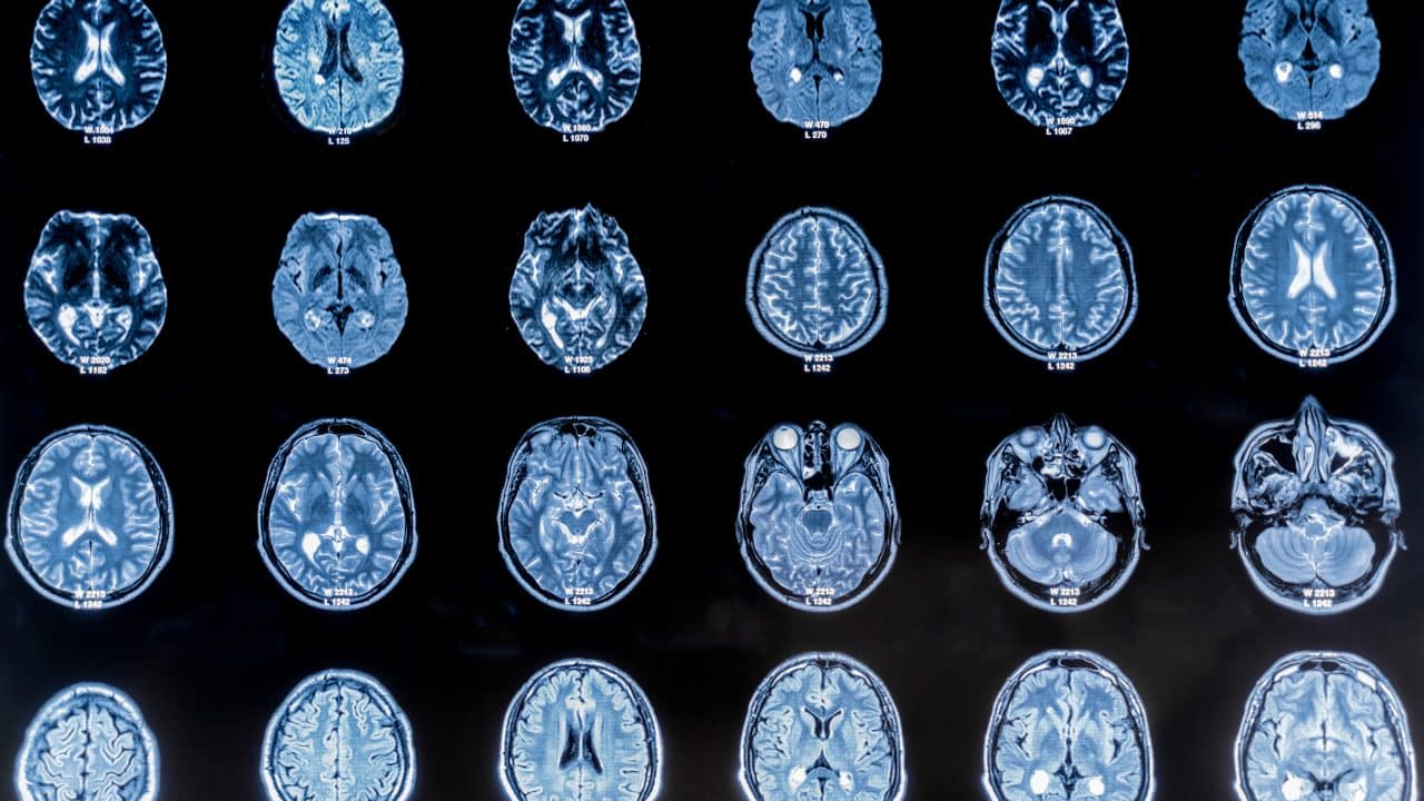 Webinaari: Alzheimerin taudin muuttuva diagnostiikka ja hoito – missä mennään?